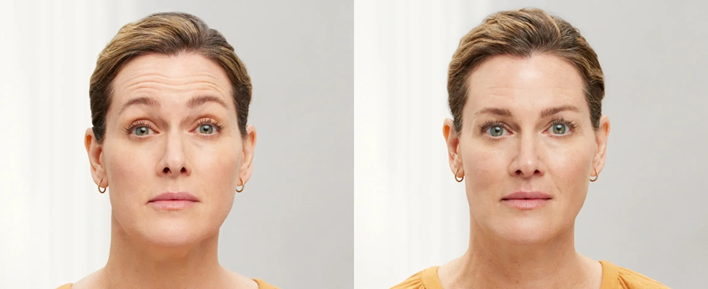 Botox before and after