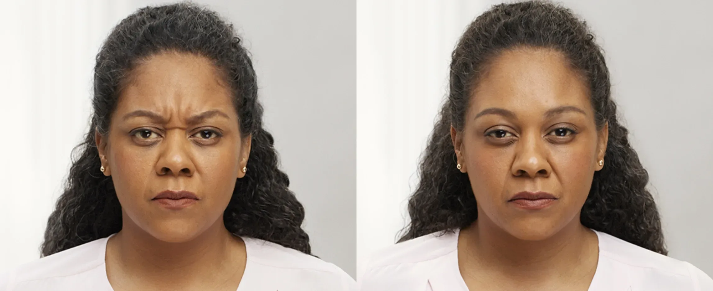 Botox before and after