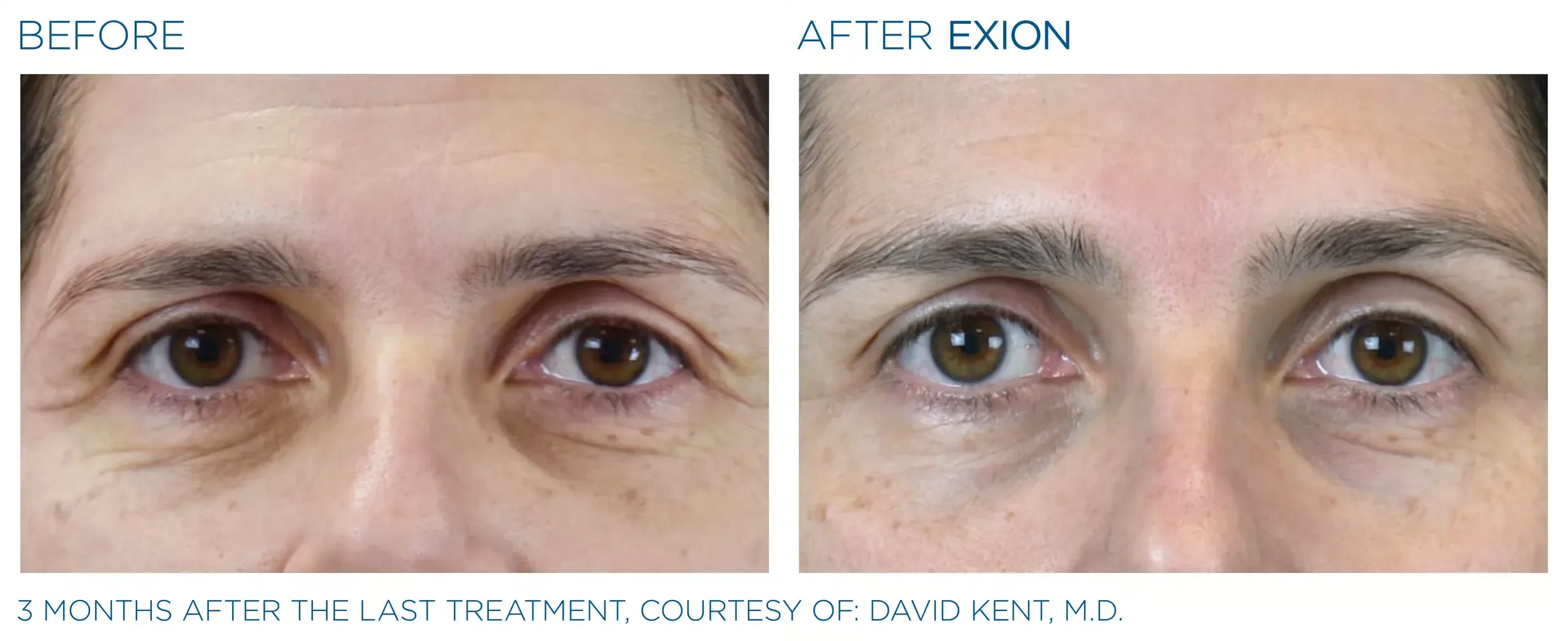 Exion Face before and after