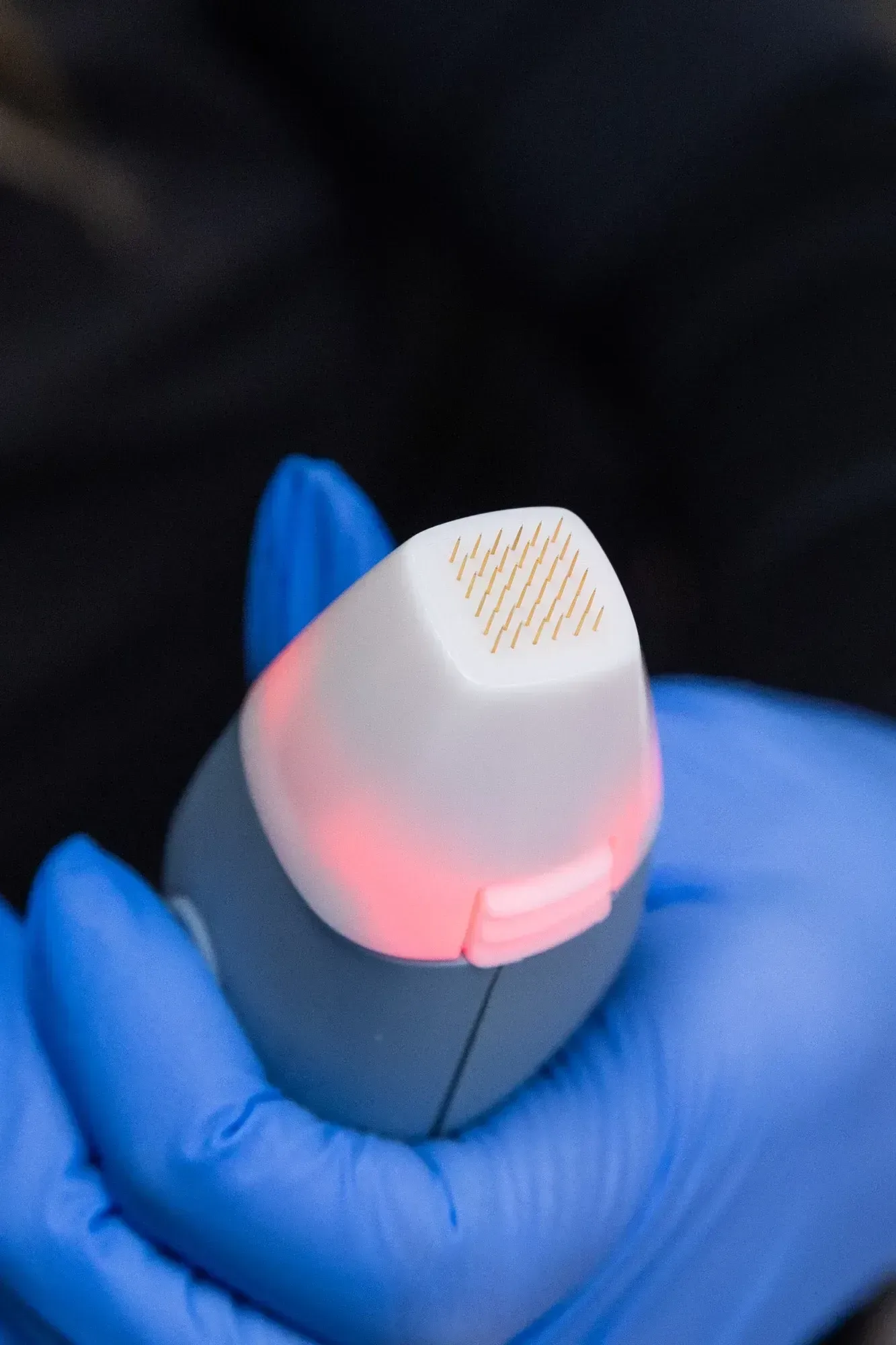 Close view of uneven skin texture and enlarged pores before RF microneedling at Applegate MedSpa in Covington