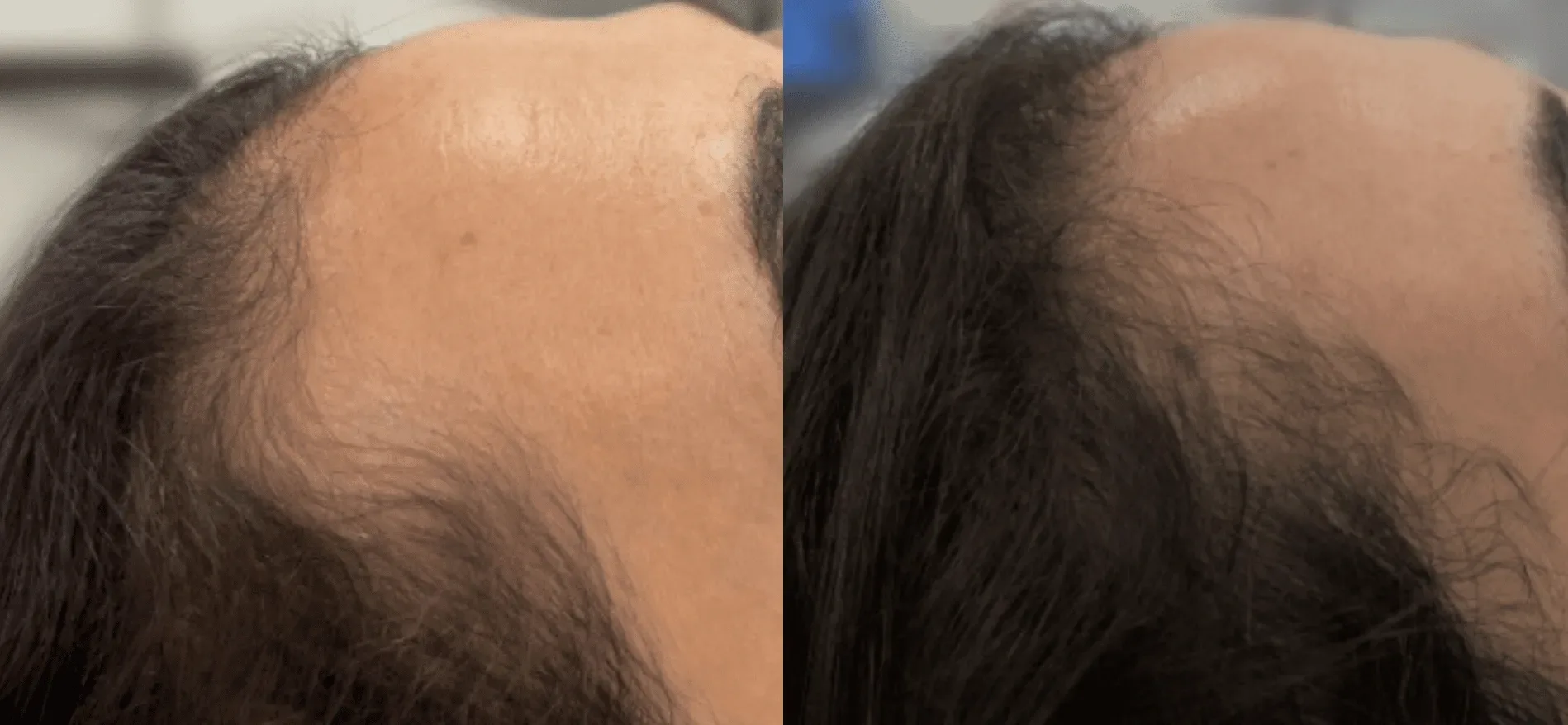 Folix Laser Hair Restoration before and after