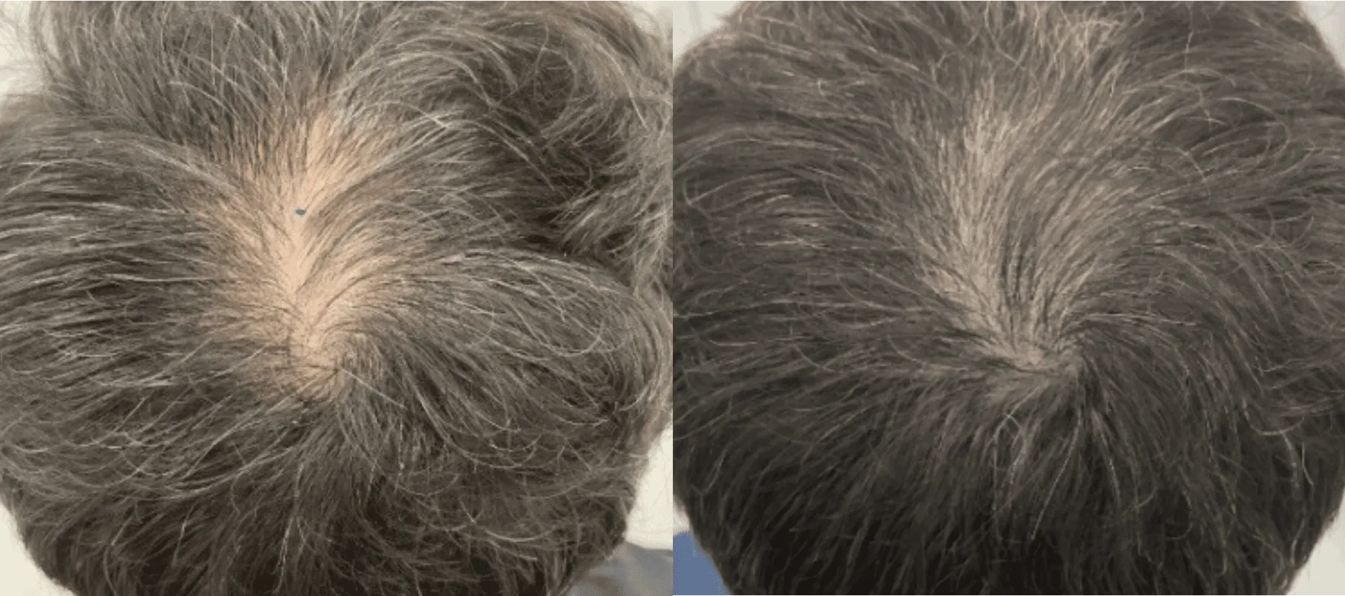 Folix Laser Hair Restoration before and after