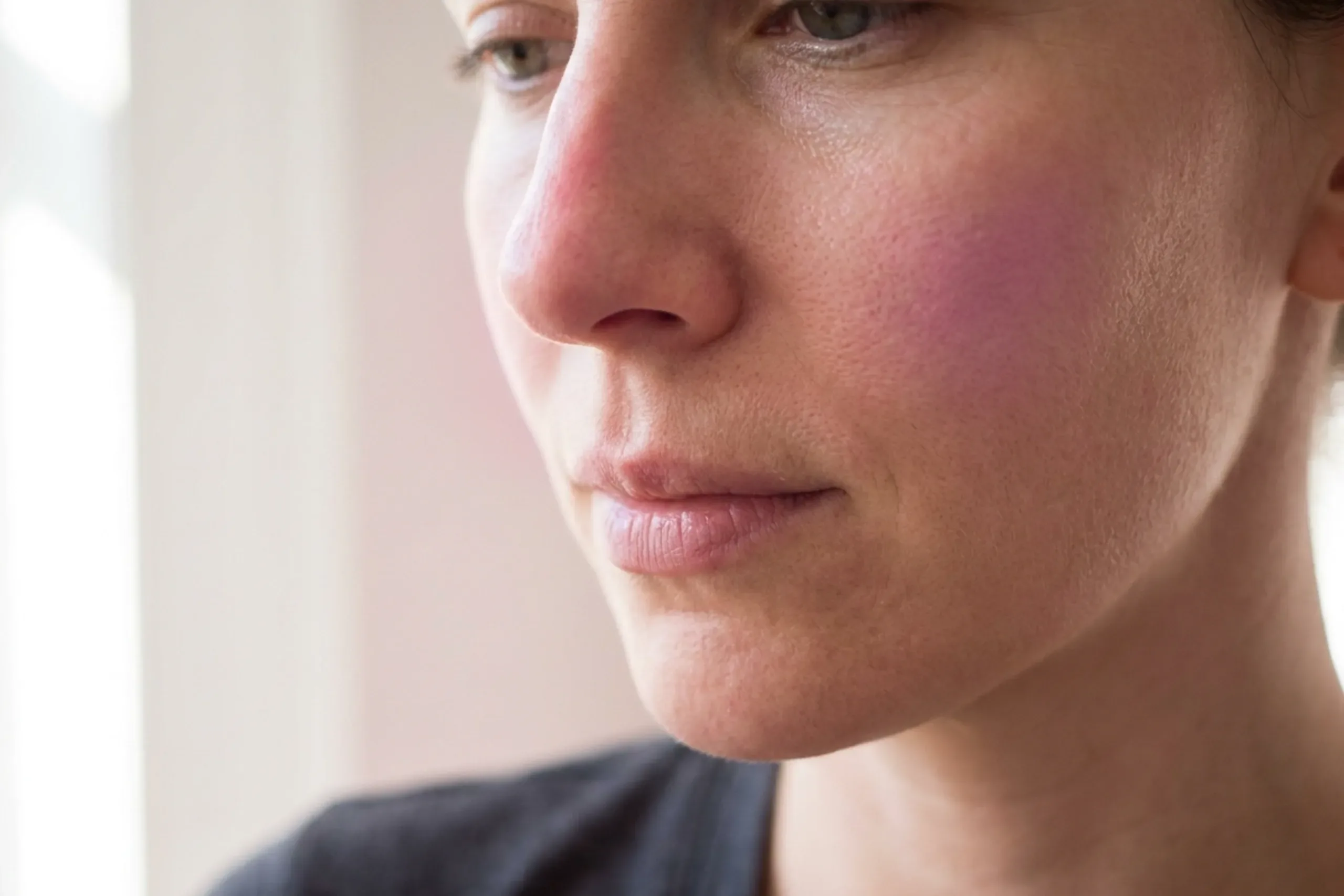 Woman looking at visibly enlarged pores across her nose and cheeks before pore treatment in Covington, KY